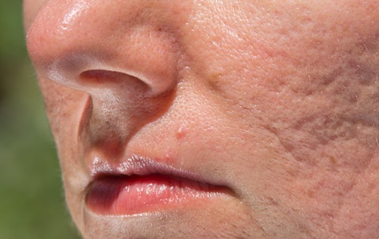 Laser Skin Resurfacing by OrangeCountySurgeons.org - 2